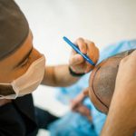 BEST HAIR TRANSPLANT DOCTOR IN ARIZONA