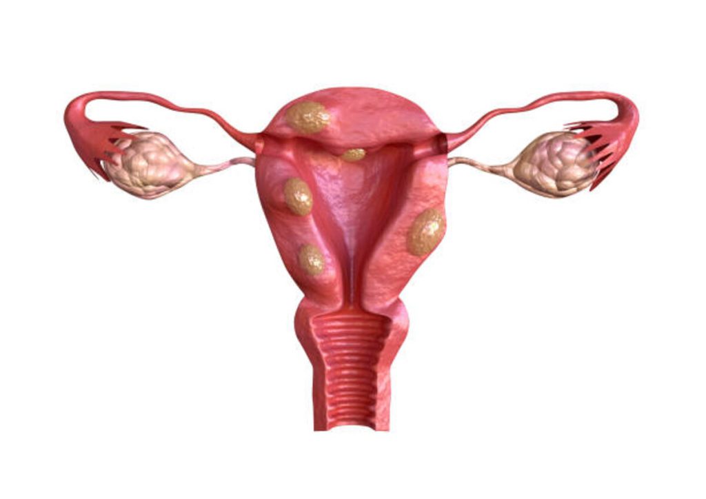 subserosal fibroid