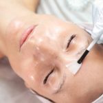 rf microneedling