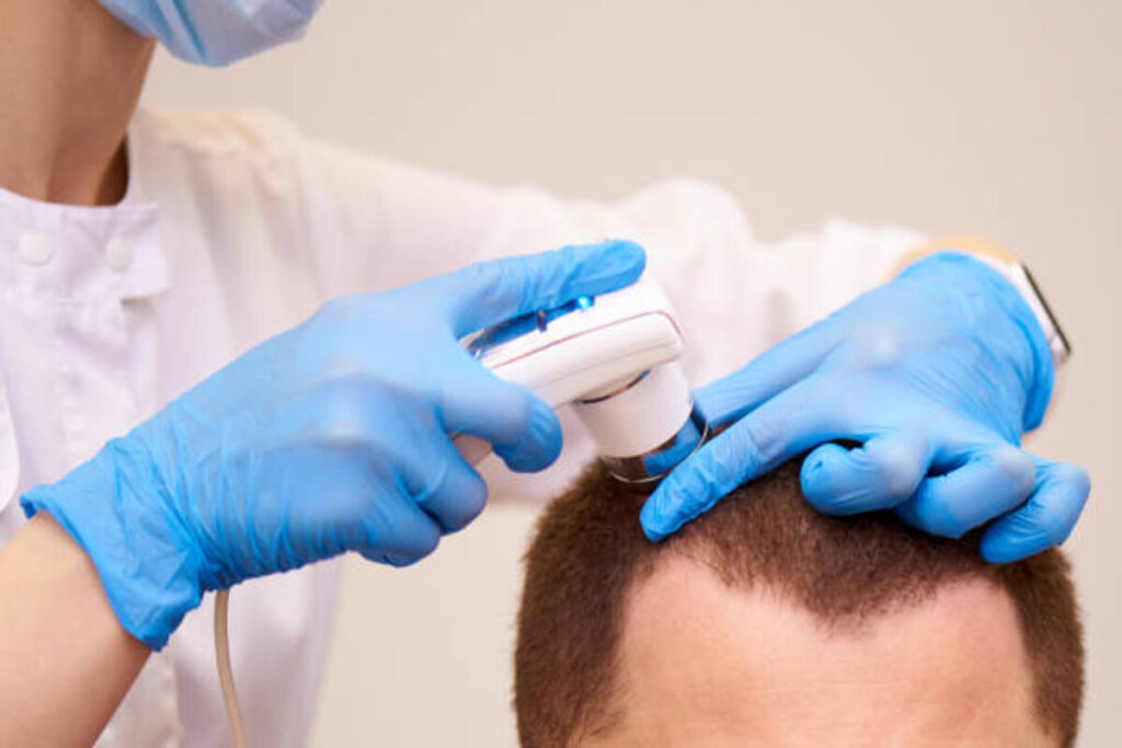 Top Treatments for Male Hair Thinning