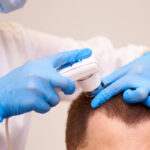 Top Treatments for Male Hair Thinning